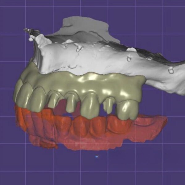 All-on-4 Implant Design Service with Thimble Bar and Hybrid Zirconia