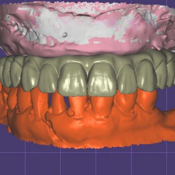 All-on-X Implant Design Service FP3 Hybrid and Surgical Guide