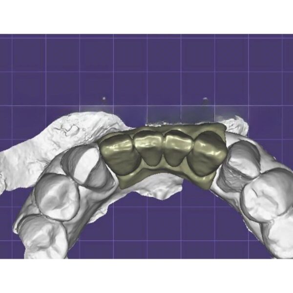 Cement Retained Implant Bridge Design on Custom Zirconia Abutments