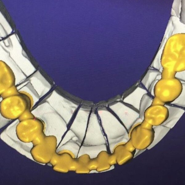 Dental Bridge Coping Design for Zirconia and Metal Frameworks
