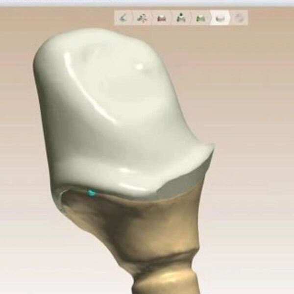 Dental Crown Coping Design for Zirconia and Metal Frameworks
