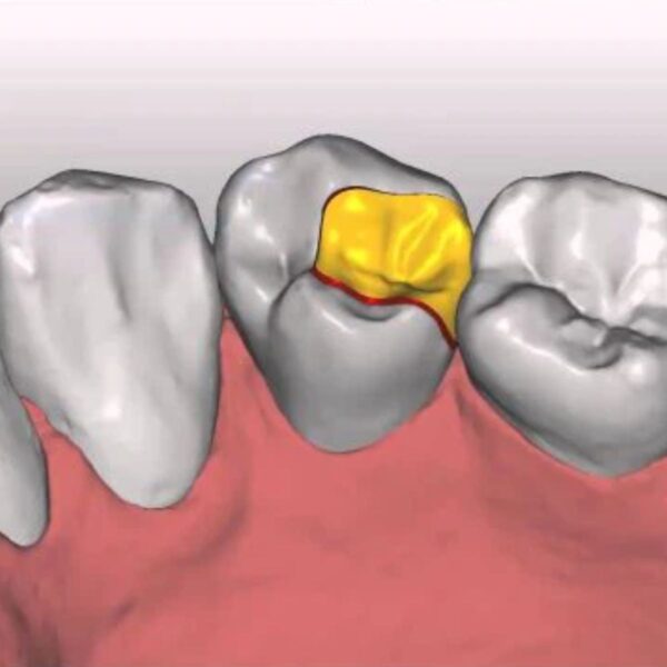 Dental Inlay Design Class II MOD for Emax and Composite