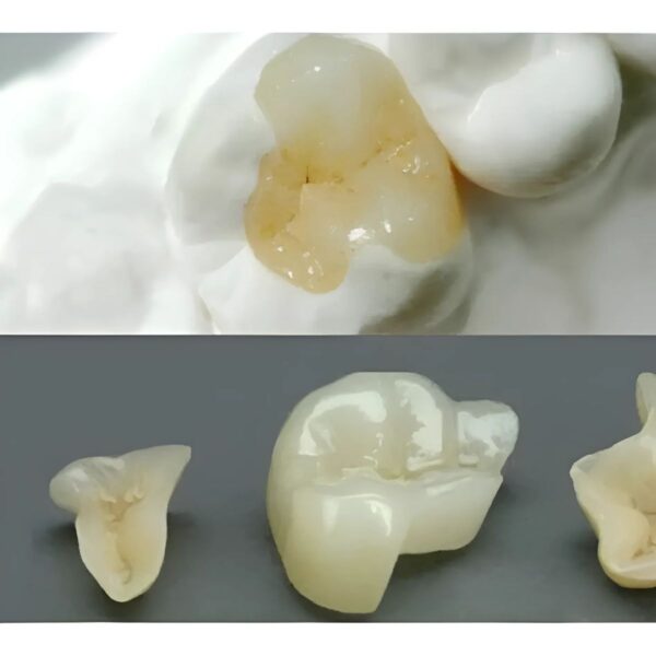 Dental Onlay Design with Cusp Coverage and Vonlay