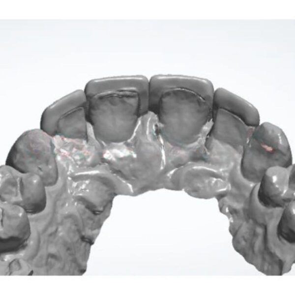 Aesthetic Dental Veneer Design Emax and Feldspathic