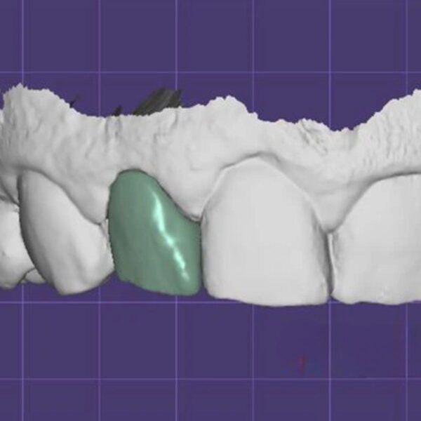 Full Anatomy Crown Design Zirconia and Emax Monolithic