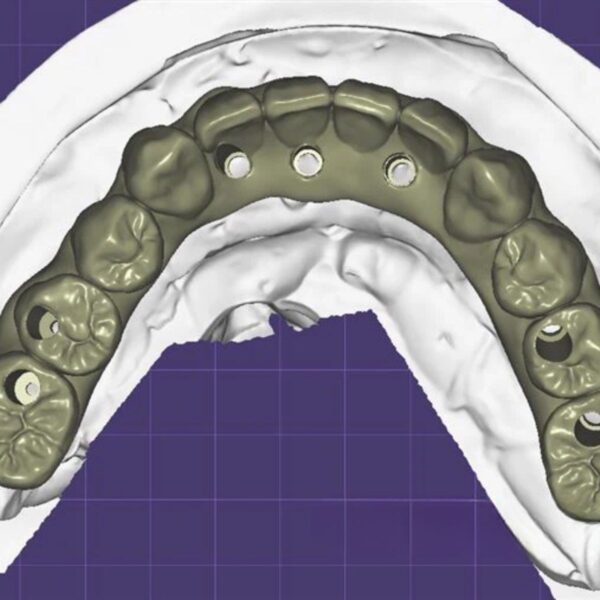 Screw Retained Implant Bridge Design on Multi Unit Abutments