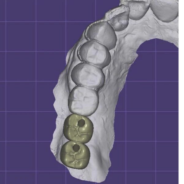 Screw Retained Implant Crown Design on TiBase with Angled Screw Channel