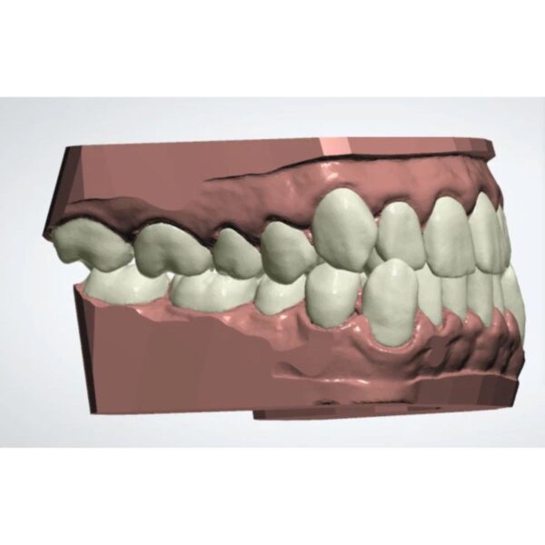 Complete clear aligners design and finish service - CAD treatment planning to production ready files