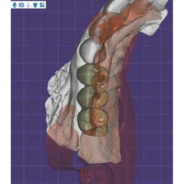 Professional dental bridge design CAD service - multi-unit bridge restoration for dental laboratories
